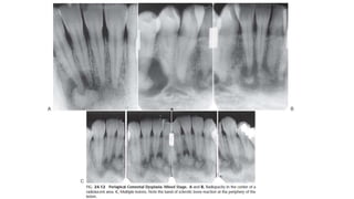 Periapical Radiopacity Classification periapical radiopacities | PPTX