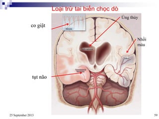 25 September 2013 59
co giật
Úng thủy
Nhồi
máu
tụt não
Loại trừ tai biến chọc dò
 