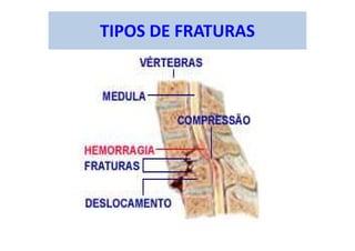TIPOS DE FRATURAS
 