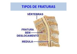 TIPOS DE FRATURAS
 