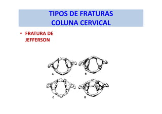 TIPOS DE FRATURAS
COLUNA CERVICAL
• FRATURA DE
JEFFERSON
 
