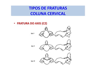 TIPOS DE FRATURAS
COLUNA CERVICAL
• FRATURA DO AXIS (C2)
 