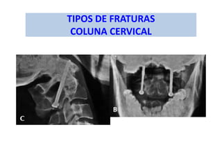 TIPOS DE FRATURAS
COLUNA CERVICAL
 