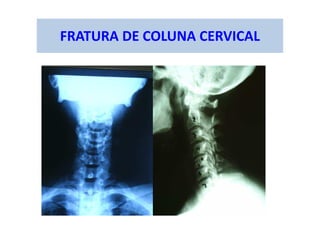 FRATURA DE COLUNA CERVICAL
 