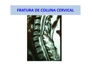 FRATURA DE COLUNA CERVICAL
 