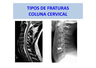 TIPOS DE FRATURAS
COLUNA CERVICAL
 
