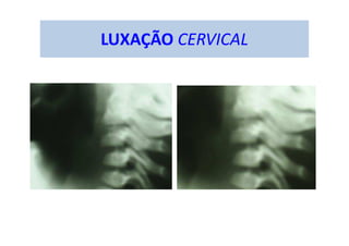 LUXAÇÃO CERVICAL
 