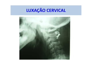 LUXAÇÃO CERVICAL
 