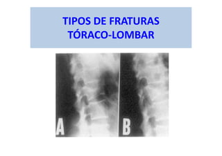 TIPOS DE FRATURAS
TÓRACO-LOMBAR
 