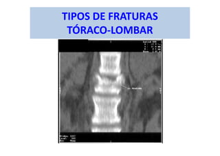 TIPOS DE FRATURAS
TÓRACO-LOMBAR
 