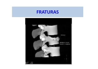 FRATURAS
 