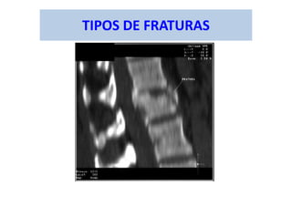 TIPOS DE FRATURAS
 