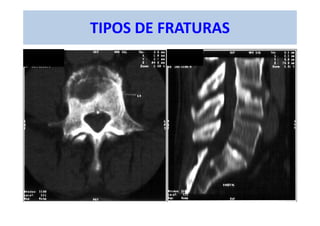 TIPOS DE FRATURAS
 
