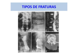 TIPOS DE FRATURAS
 