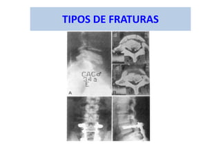 TIPOS DE FRATURAS
 