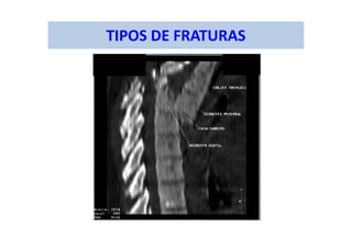 TIPOS DE FRATURAS
 