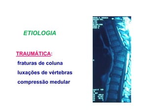 ETIOLOGIA
TRAUMÁTICA:
fraturas de coluna
luxações de vértebras
compressão medular
 