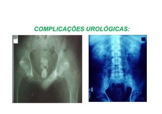 COMPLICAÇÕES UROLÓGICAS:
 