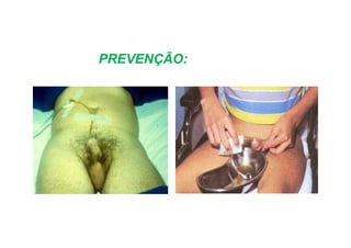 PREVENÇÃO:
 