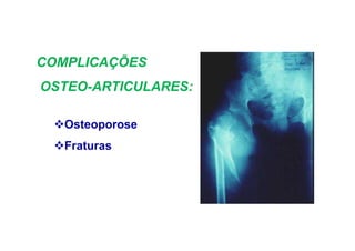 Osteoporose
Fraturas
COMPLICAÇÕES
OSTEO-ARTICULARES:
 
