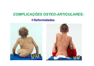 COMPLICAÇÕES OSTEO-ARTICULARES:
Deformidades
 