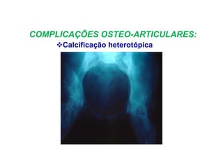 COMPLICAÇÕES OSTEO-ARTICULARES:
Calcificação heterotópica
 