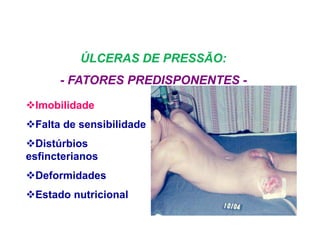 Imobilidade
Falta de sensibilidade
Distúrbios
esfincterianos
Deformidades
Estado nutricional
ÚLCERAS DE PRESSÃO:
- FATORES PREDISPONENTES -
 