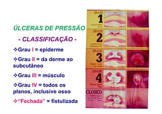Grau I = epiderme
Grau II = da derme ao
subcutâneo
Grau III = músculo
Grau IV = todos os
planos, inclusive osso
“Fechada” = fistulizada
ÚLCERAS DE PRESSÃO
- CLASSIFICAÇÃO -
 