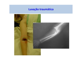 Luxação traumática
 