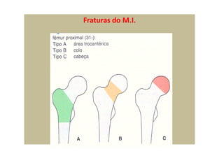 Fraturas do M.I.
 