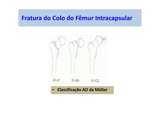 Fratura do Colo do Fêmur Intracapsular
• Classificação AO de Müller
 