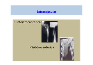 Extracapsular
• Intertrocantérica
»Subtrocantérica
 