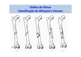 Diáfise do Fêmur
Classificação de Winquist e Hansen
 