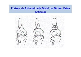 Fratura da Extremidade Distal do Fêmur Extra
Articular
 