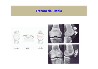 Fratura da Patela
 