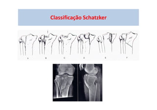 Classificação Schatzker
 