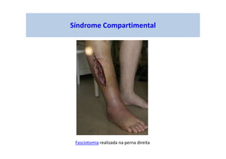 Síndrome Compartimental
Fasciotomia realizada na perna direita
 