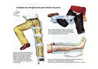 figura
10/12/2015 Dr. José Heitor M.Fernandes 50
Cuidados de emergência da parte inferior da perna
 