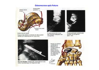 figura
Dr. José Heitor M.Fernandes 57
Osteonecrose após fratura
 