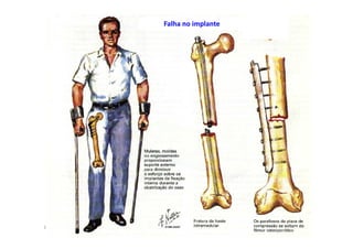 figura
10/12/2015 Dr. José Heitor M.Fernandes 61
Falha no implante
 