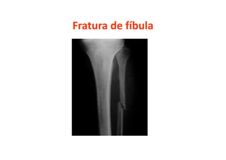 Fratura de fíbula
 