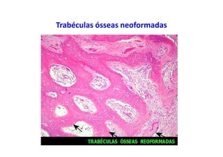 Trabéculas ósseas neoformadas
 