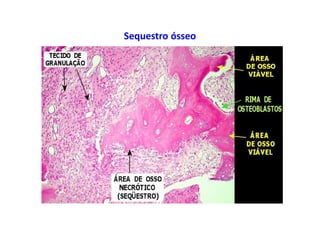 Sequestro ósseo
 