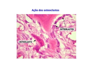 Ação dos osteoclastos
 