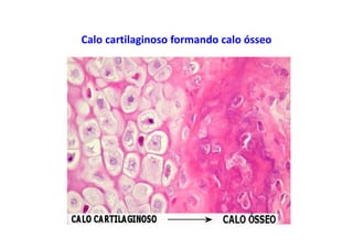 Calo cartilaginoso formando calo ósseo
 