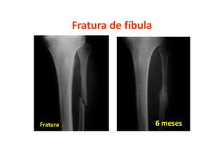 Fratura de fíbula
6 mesesFratura
 