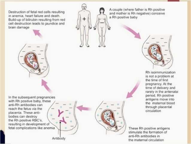 Management Of Rh Negative Pregnancy Management Of Rh Negative Pregnancy