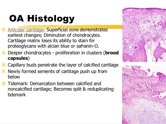 break how bone lecture UG for Osteoarthritis