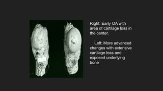 Right: Early OA with
area of cartilage loss in
the center.
Left: More advanced
changes with extensive
cartilage loss and
exposed underlying
bone
 