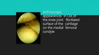 Arthroscopic
appearances in OA of
the knee joint: fibrillated
surface of the cartilage
on the medial femoral
condyle
 